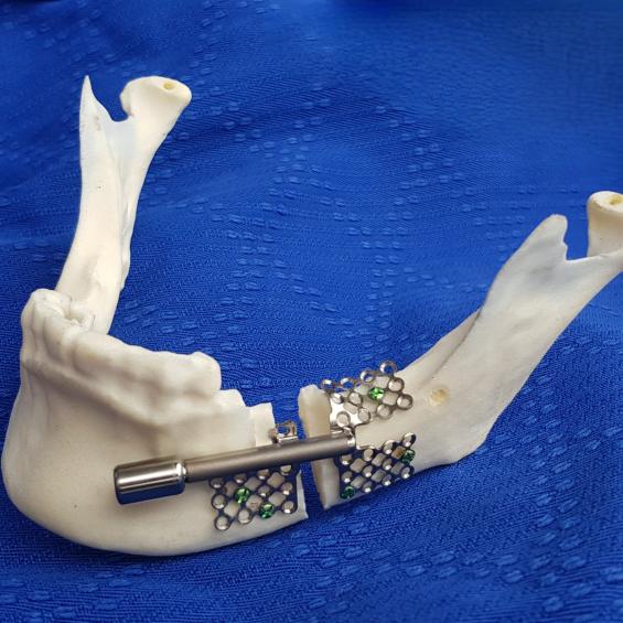 Mechanics and maxillofacial surgery, the winning duo